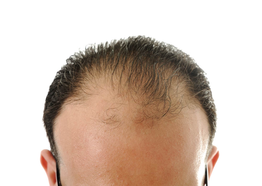 Laser Lipo House | laser hair treatment for white men