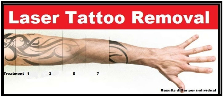 laser, lipo, house, tattoo, removal, treatment, explained, remove, description, example, contrast, tattoo removal diagram,